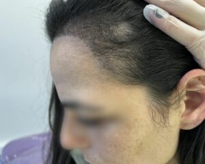 μεταμόσχευση μαλλιών στη τουρκία 
