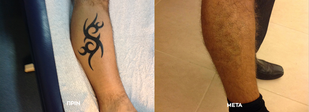 Tattoo Removal with Pico Laser 1 before after karalexistatouaz1 1