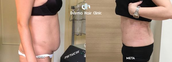 Λιποαναρρόφηση με Laser 2 before after