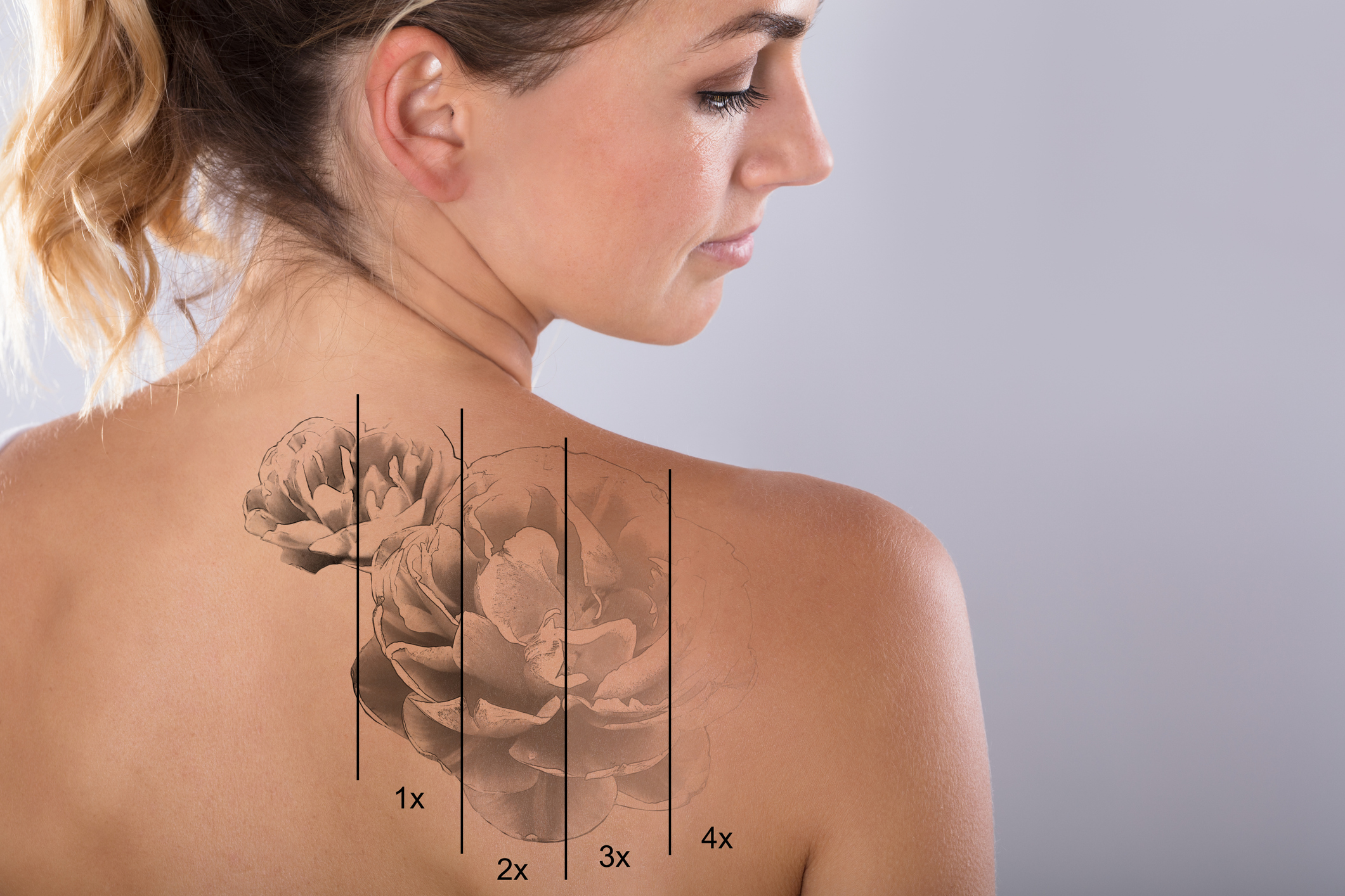 Tattoo Removal with Pico Laser 3 iStock 917893110